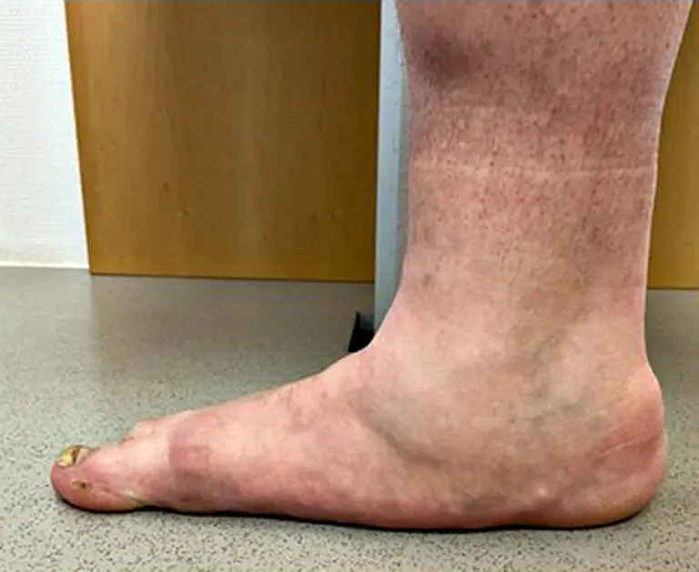 Unbehandelte Tibialis-posterior-Insuffizienz am Fuß