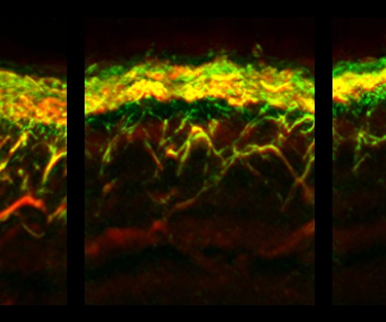 RSOM-Aufnahmen von Haut eines gesunden Probanden (links), eines Patienten mit Diabetes (mitte) und eines Patienten mit Diabetes und Neuropathie (rechts).