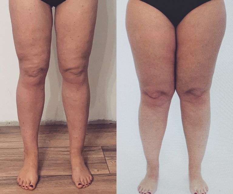 Karoline Schades Beine vor (rechts) und nach der Operation (links).